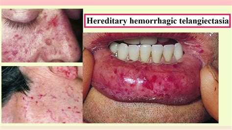 Hereditary hemorrhagic telangiectasia .